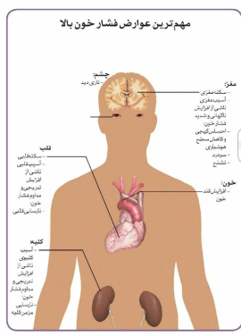 مهمترین عوارض فشار خون بالا فشار خون را شوخی نگیرید!